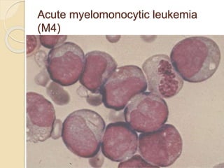 Acute myelomonocytic leukemia
(M4)
 