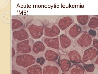 Acute monocytic leukemia
(M5)
 