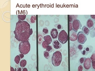 Acute erythroid leukemia
(M6)
 