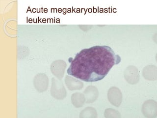 Acute megakaryoblastic
leukemia
 