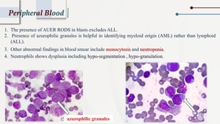 Peripheral Blood
1. The presence of AUER RODS in blasts excludes ALL.
2. Presence of azurophilic granules is helpful in identifying myeloid origin (AML) rather than lymphoid
(ALL).
3. Other abnormal findings in blood smear include monocytosis and neutropenia.
4. Neutrophils shows dysplasia including hypo-segmentation , hypo-granulation.
azurophilic granules
 