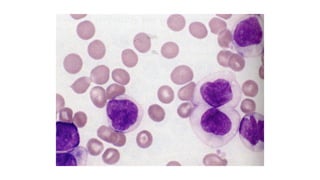 Acute myeloid leukemia, its clinical features | PPTX