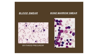 Acute myeloid leukemia, its clinical features | PPTX