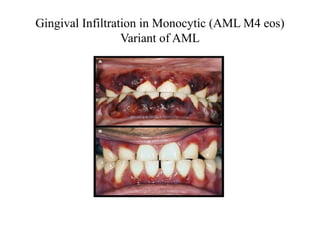 Gingival Infiltration in Monocytic (AML M4 eos)
Variant of AML
 
