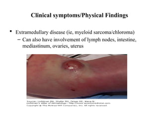 Clinical symptoms/Physical Findings
 Extramedullary disease (ie, myeloid sarcoma/chloroma)
– Can also have involvement of lymph nodes, intestine,
mediastinum, ovaries, uterus
 