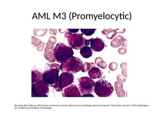AML M3 (Promyelocytic)
Brunning, RD, McKenna, RW. Tumors of the bone marrow. Atlas of tumor pathology (electronic fascicle), Third series, fascicle 9, 1994, Washington,
DC. Armed Forces Institute of Pathology.
 