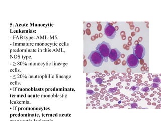 5. Acute Monocytic
Leukemias:
- FAB type: AML-M5.
- Immature monocytic cells
predominate in this AML,
NOS type.
- ≥ 80% monocytic lineage
cells.
- ≤ 20% neutrophilic lineage
cells.
• If monoblasts predominate,
termed acute monoblastic
leukemia.
• If promonocytes
predominate, termed acute
 
