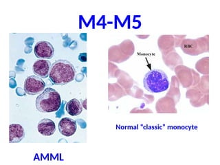 M4-M5
AMML
Normal “classic” monocyte
 