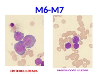 M6-M7
ERYTHROLEUKEMIA MEGAKARYOCYTIC LEUKEMIA
 