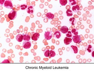 Chronic Myeloid Leukemia
 