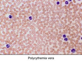 Polycythemia vera
 