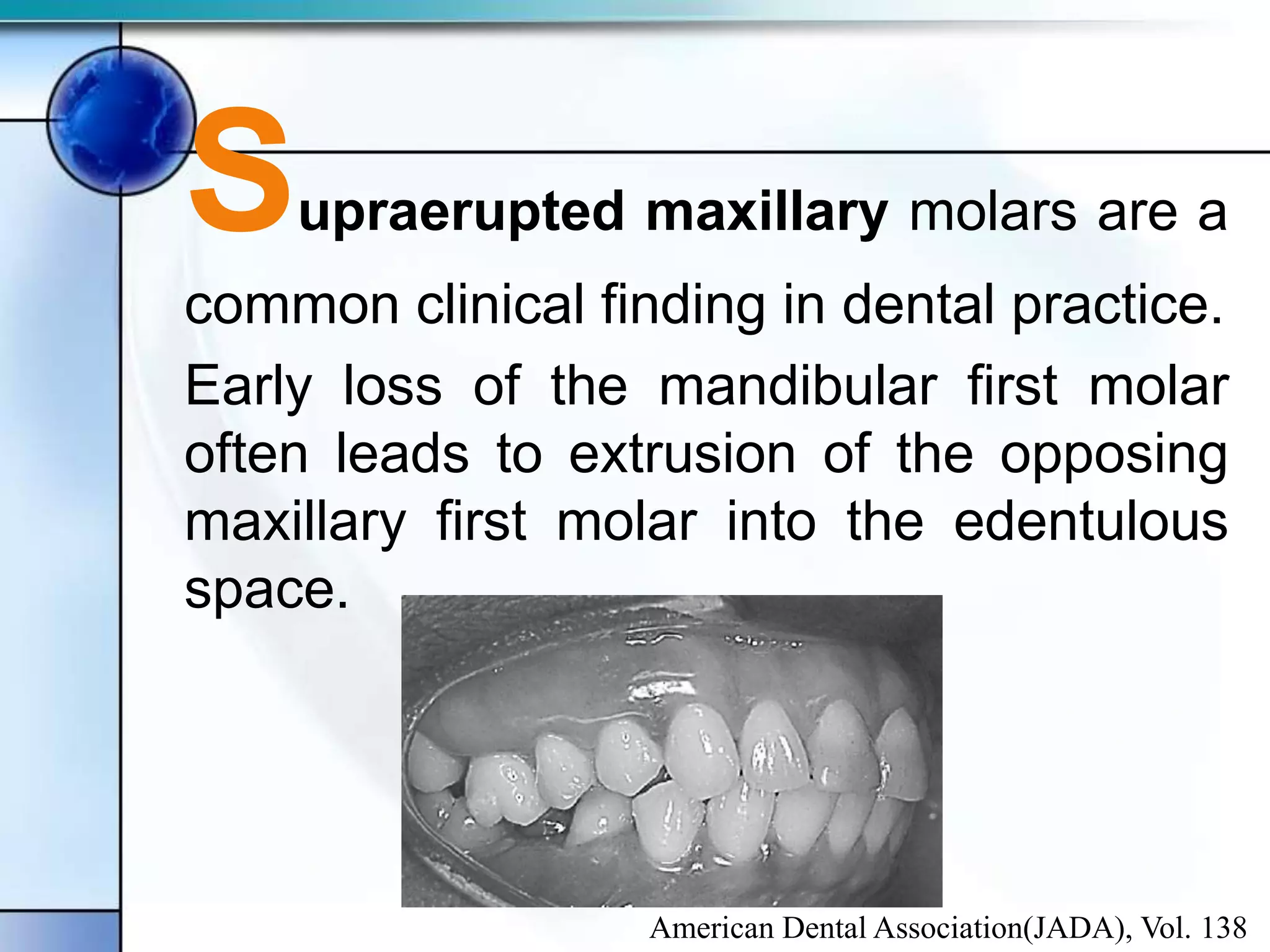 The use of temporary anchorage devices for molar intrusion | PPT