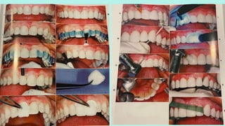 Preparation of tooth-surface before cementation