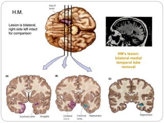 HM’s lesion:
bilateral medial
temporal lobe
removal
 