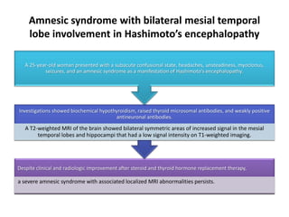 Amnesic syndrome with bilateral mesial temporal
lobe involvement in Hashimoto’s encephalopathy
Despite clinical and radiologic improvement after steroid and thyroid hormone replacement therapy,
a severe amnesic syndrome with associated localized MRI abnormalities persists.
Investigations showed biochemical hypothyroidism, raised thyroid microsomal antibodies, and weakly positive
antineuronal antibodies.
A T2-weighted MRI of the brain showed bilateral symmetric areas of increased signal in the mesial
temporal lobes and hippocampi that had a low signal intensity on T1-weighted imaging.
A 25-year-old woman presented with a subacute confusional state, headaches, unsteadiness, myoclonus,
seizures, and an amnesic syndrome as a manifestation of Hashimoto’s encephalopathy.
 