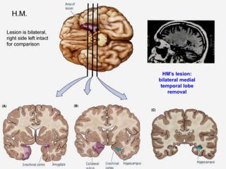 HM’s lesion:
bilateral medial
temporal lobe
removal
 