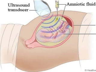 amniocentesis.pptx