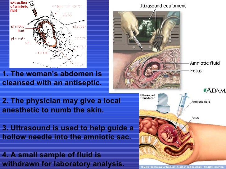 Amniocentesis ((Slide Show))