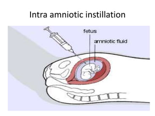 Intra amniotic instillation
 