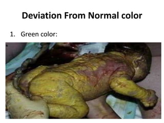 Deviation From Normal color
1. Green color:
 