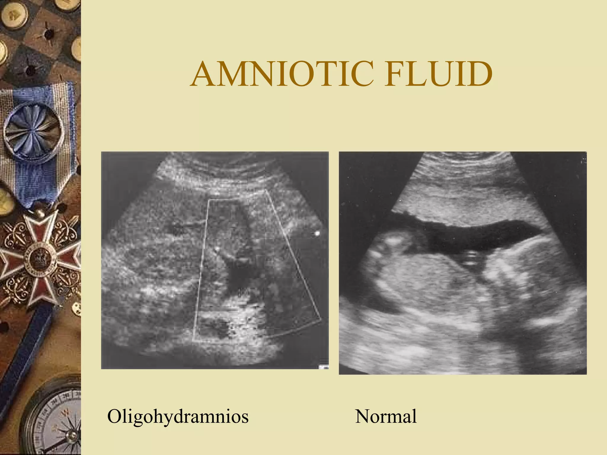 AMNIOTIC FLUID Oligohydramnios  Normal 
