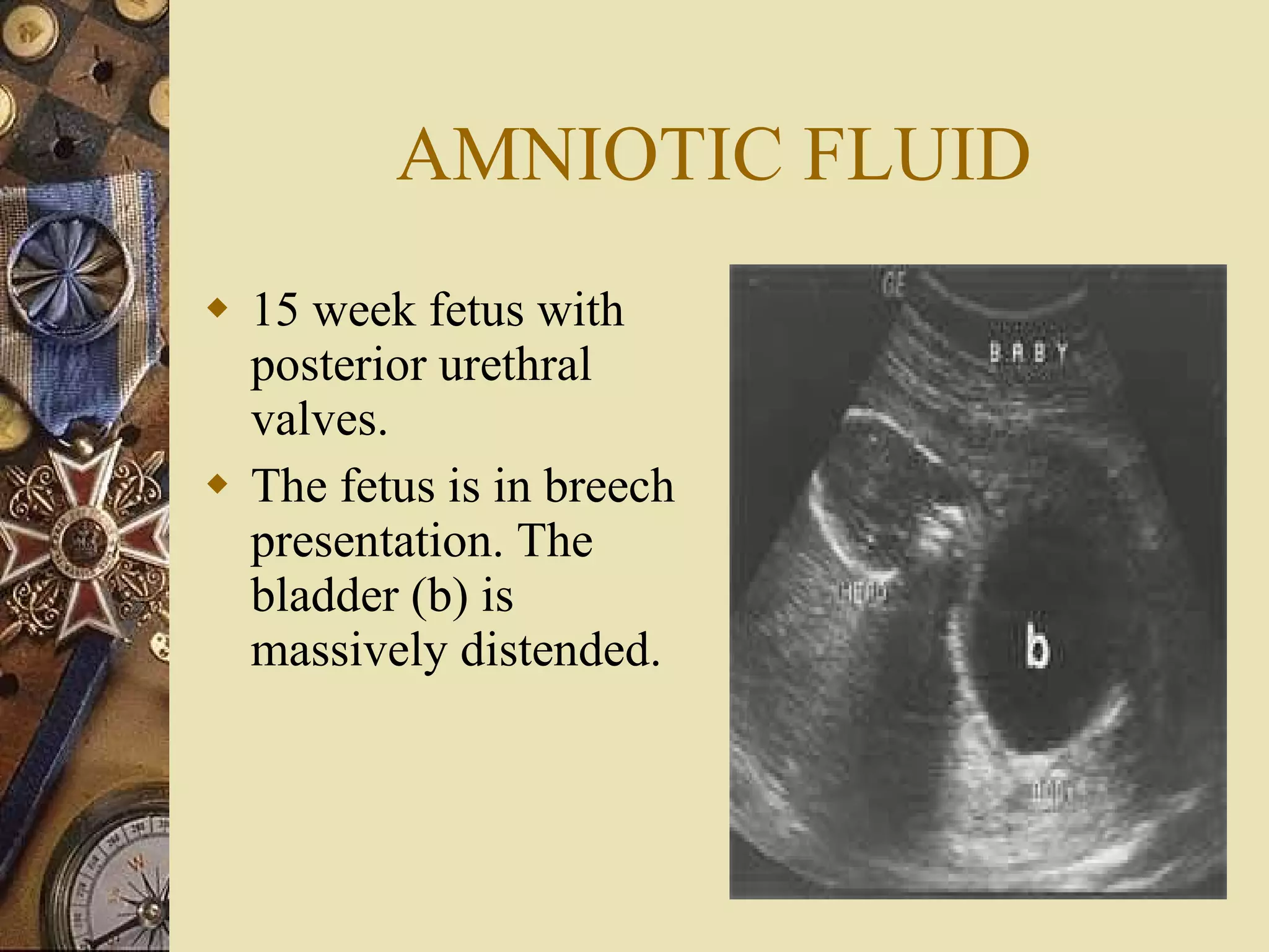 AMNIOTIC FLUID 15 week fetus with posterior urethral valves.  The fetus is in breech presentation. The bladder (b) is massively distended.  