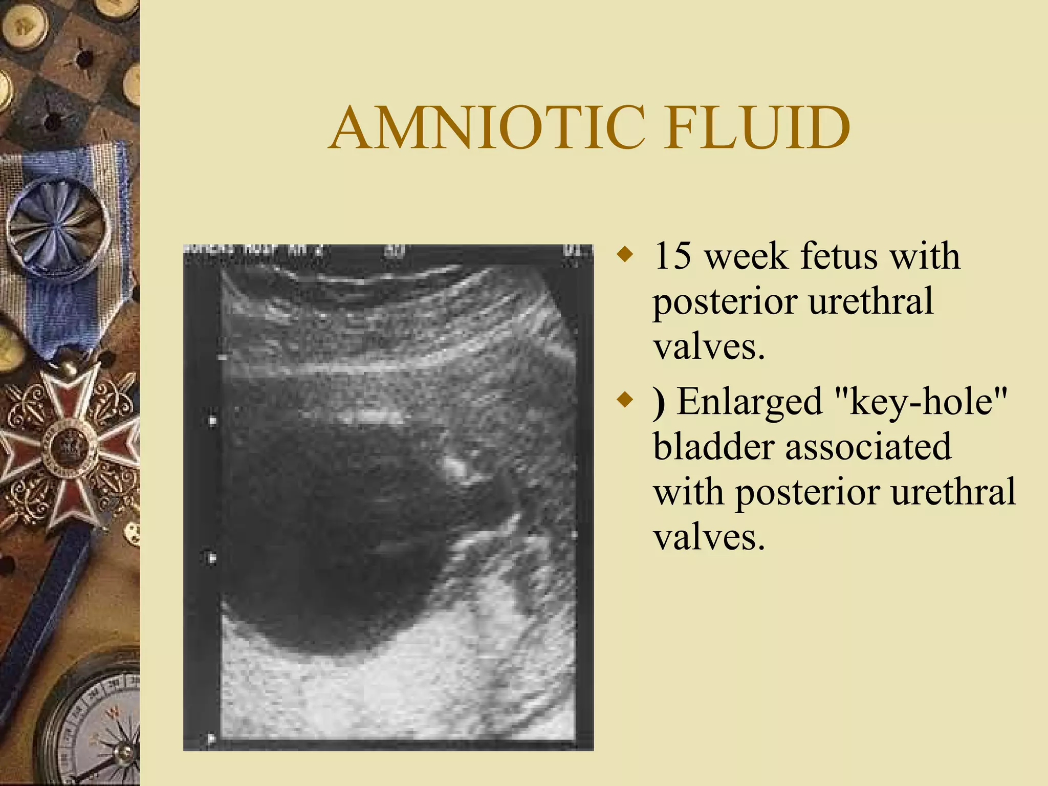 AMNIOTIC FLUID 15 week fetus with posterior urethral valves.  )  Enlarged "key-hole" bladder associated with posterior urethral valves.  