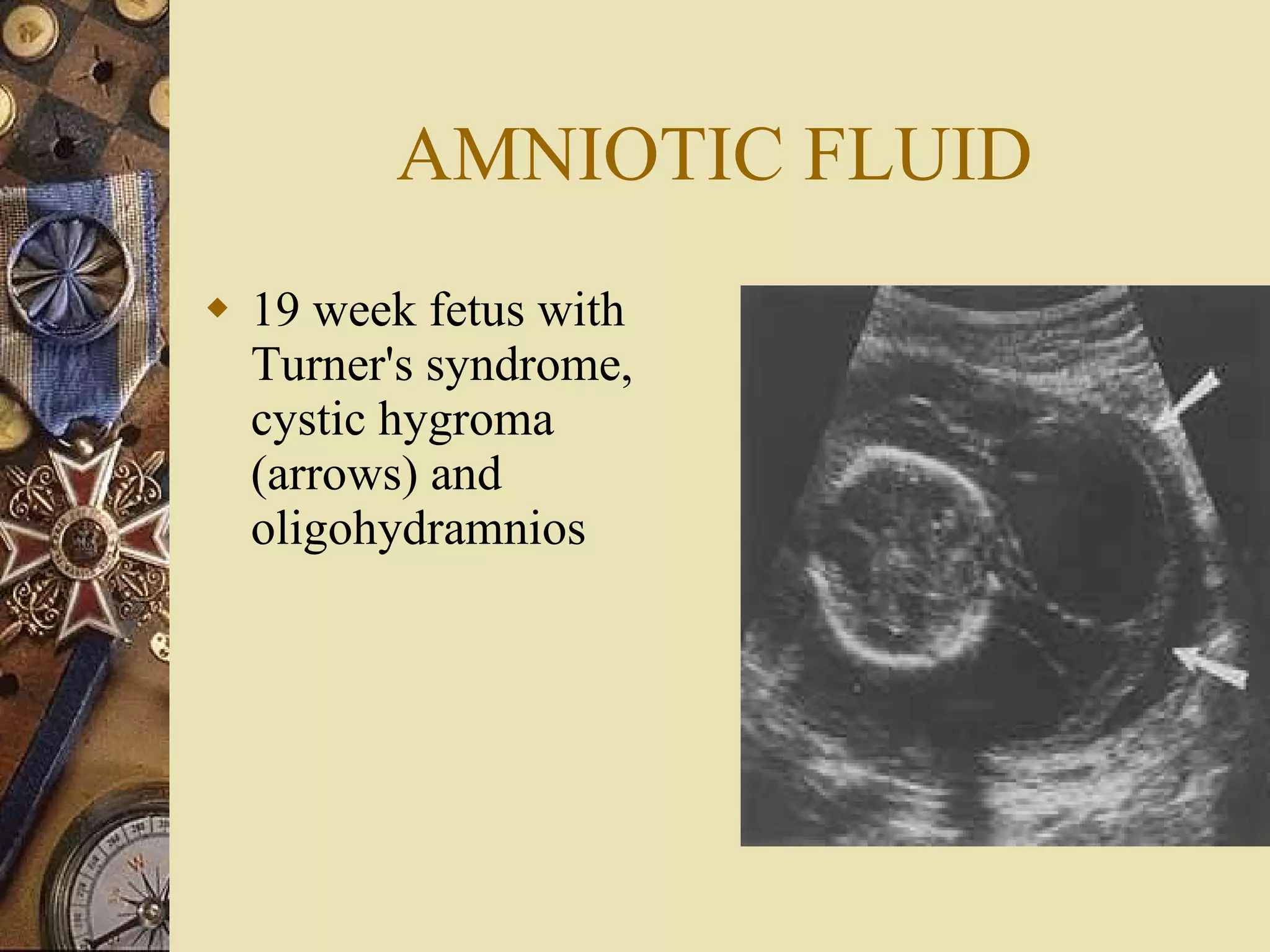 AMNIOTIC FLUID 19 week fetus with Turner's syndrome, cystic hygroma (arrows) and oligohydramnios  