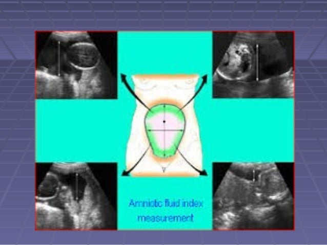 Amniotic Fluid Index Ultrasound