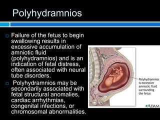Polyhydramnios
 Failure of the fetus to begin
swallowing results in
excessive accumulation of
amniotic fluid
(polyhydramnios) and is an
indication of fetal distress,
often associated with neural
tube disorders.
 Polyhydramnios may be
secondarily associated with
fetal structural anomalies,
cardiac arrhythmias,
congenital infections, or
chromosomal abnormalities.
 