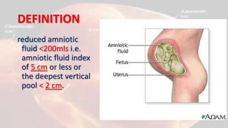 DEFINITION
reduced amniotic
fluid <200mls i.e.
amniotic fluid index
of 5 cm or less or
the deepest vertical
pool < 2 cm.
 