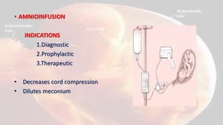 • AMNIOINFUSION
INDICATIONS
1.Diagnostic
2.Prophylactic
3.Therapeutic
• Decreases cord compression
• Dilutes meconium
 