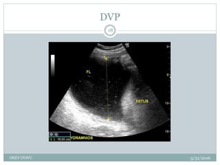 DVP
5/31/2016OKEY UGWU
18
 