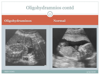 Oligohydraminos Normal
5/31/2016OKEY UGWU
31
Oligohydramnios contd
 