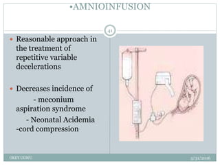 •AMNIOINFUSION
5/31/2016OKEY UGWU
41
 Reasonable approach in
the treatment of
repetitive variable
decelerations
 Decreases incidence of
- meconium
aspiration syndrome
- Neonatal Acidemia
-cord compression
 