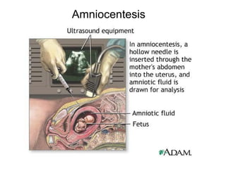 Amniocentesis
 