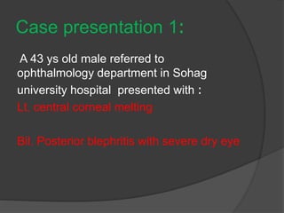 :Case presentation 1
A 43 ys old male referred to
ophthalmology department in Sohag
:university hospital presented with
Lt. central corneal melting
Bil. Posterior blephritis with severe dry eye
 