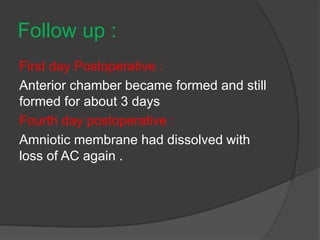 Follow up :
First day Postoperative :
Anterior chamber became formed and still
formed for about 3 days
Fourth day postoperative :
Amniotic membrane had dissolved with
loss of AC again .
 
