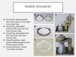 Amniotic membrane in ophthalmology | PPTX