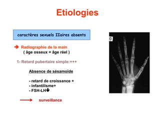 Etiologies
 Radiographie de la main
( âge osseux = âge réel )
1- Retard pubertaire simple:+++
Absence de sésamoïde
- retard de croissance +
- infantilisme+
- FSH-LH
surveillance
caractères sexuels IIaires absents
 