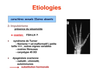 Etiologies
2- Impubérisme
présence du sésamoïde
a- ovarien: FSH-LH 
 syndrome de Turner
- Nanisme + sd malformatif ( petite
taille +++ , autres signes variables
- ovaires fibreuses
- caryotype 45 XO
 dysgénésie ovarienne
- radiottt ; chimiottt;
autoimmunes
substitution hormonale
caractères sexuels IIaires absents
 