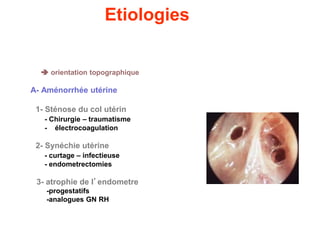 Etiologies
 orientation topographique
A- Aménorrhée utérine
1- Sténose du col utérin
- Chirurgie – traumatisme
- électrocoagulation
2- Synéchie utérine
- curtage – infectieuse
- endometrectomies
3- atrophie de l’endometre
-progestatifs
-analogues GN RH
 
