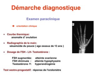 Démarche diagnostique
Examen paraclinique
 orientation clinique
 Courbe thermique:
anomalie d’ovulation
 Radiographie de la main:
sésamoïde du pouce ( age osseux de 13 ans )
 Dosage de FSH - LH- Testostérone :
FSH augmentée: atteinte ovarienne
FSH diminuée : atteinte hypophysaire
Testostérone : hyperandrogénie
Test oestro-progestatif: réponse de l’endomètre
 