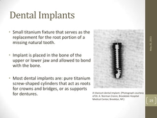 • Small titanium fixture that serves as the
replacement for the root portion of a
missing natural tooth.
• Implant is placed in the bone of the
upper or lower jaw and allowed to bond
with the bone.
• Most dental implants are: pure titanium
screw-shaped cylinders that act as roots
for crowns and bridges, or as supports
for dentures.
Dental Implants
May20,2013
19
A titanium dental implant. (Photograph courtesy
of Dr. A. Norman Cranin, Brookdale Hospital
Medical Center, Brooklyn, NY.)
 
