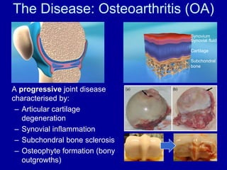 The Disease: Osteoarthritis (OA)SynoviumSynovial fluidCartilageSubchondral bone	A progressive joint disease characterised by:Articular cartilage degenerationSynovial inflammationSubchondral bone sclerosisOsteophyte formation (bony outgrowths)