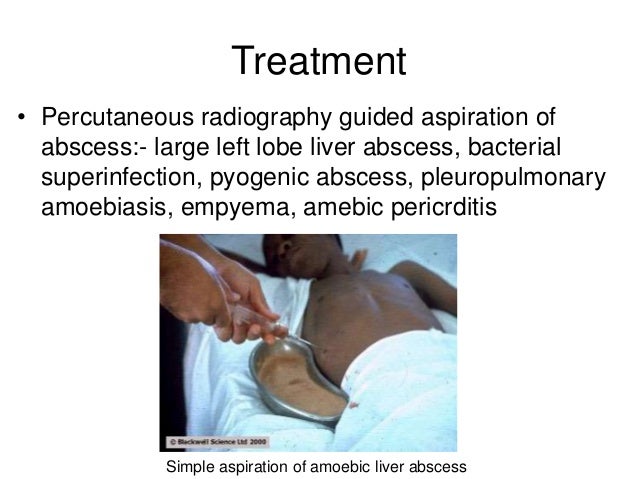 Chloroquine Dose In Amoebic Liver Abscess