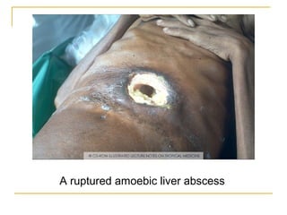 A ruptured amoebic liver abscess
 