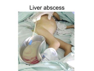 Liver abscess