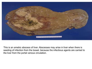 This is an amebic abscess of liver. Abscesses may arise in liver when there is
seeding of infection from the bowel, because the infectious agents are carried to
the liver from the portal venous circulation.