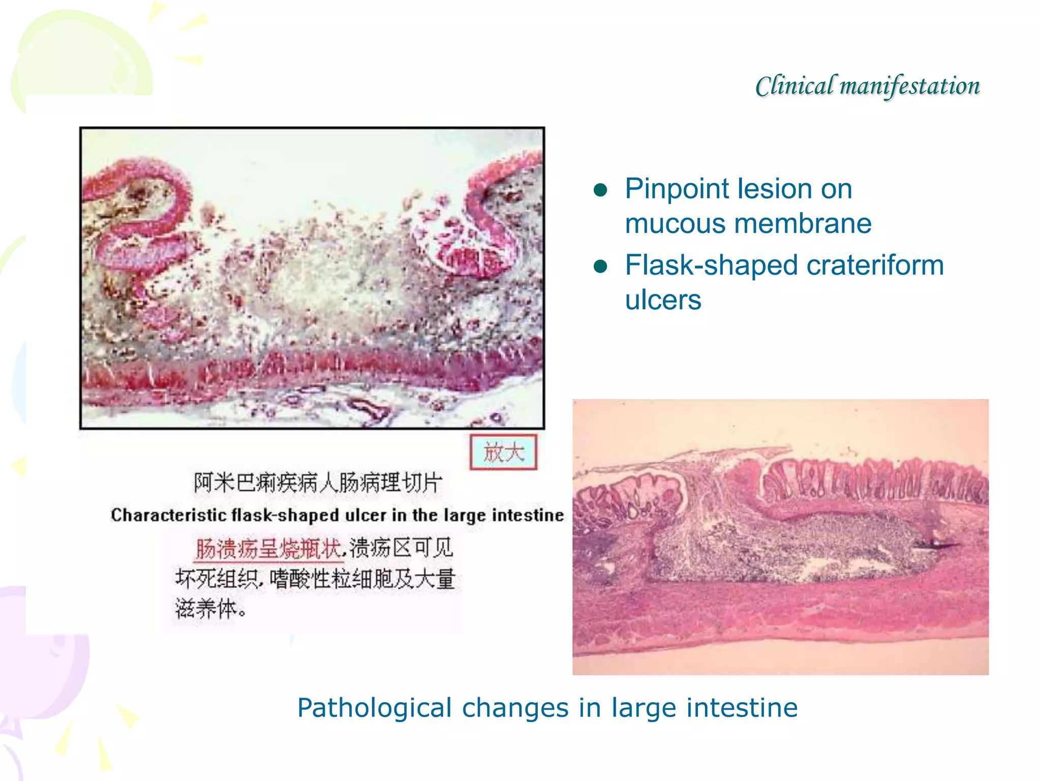 •
Clinical manifestation
 Pinpoint lesion on
mucous membrane
 Flask-shaped crateriform
ulcers
Pathological changes in large intestine
 